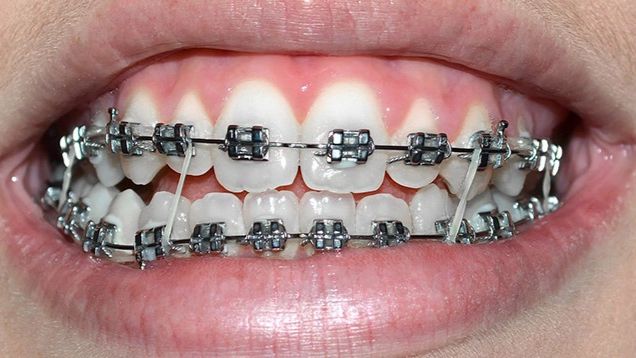 Tác Hại Niềng Răng Giá Rẻ